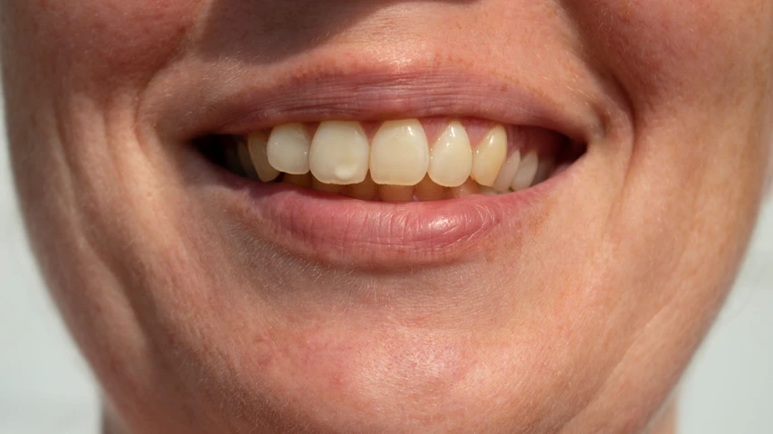 Fluorosis